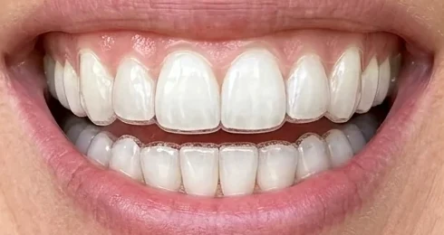 Smile wearing Smilewave aligners with smooth teeth and no attachments