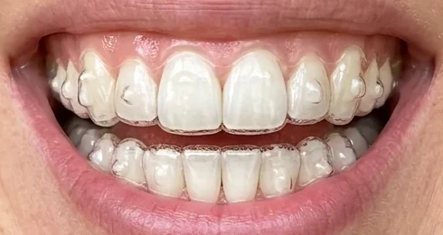 Smile wearing typical clear aligners with visible attachments bonded to the teeth